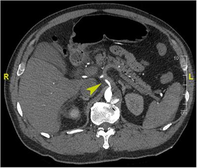 Postoperative Hepatic Dysfunction After Frozen Elephant Trunk for Type A Aortic Dissection